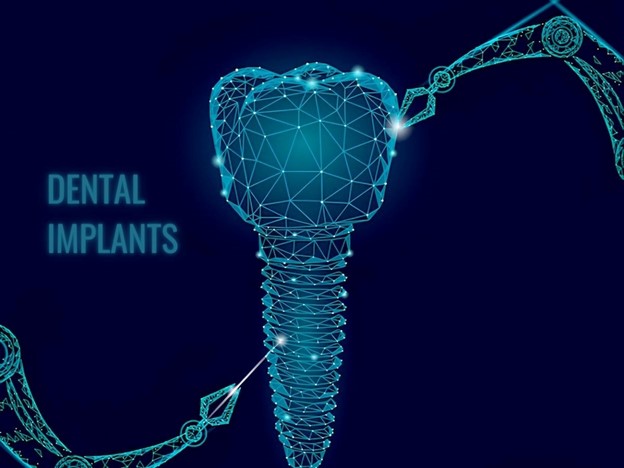 Dental Implants