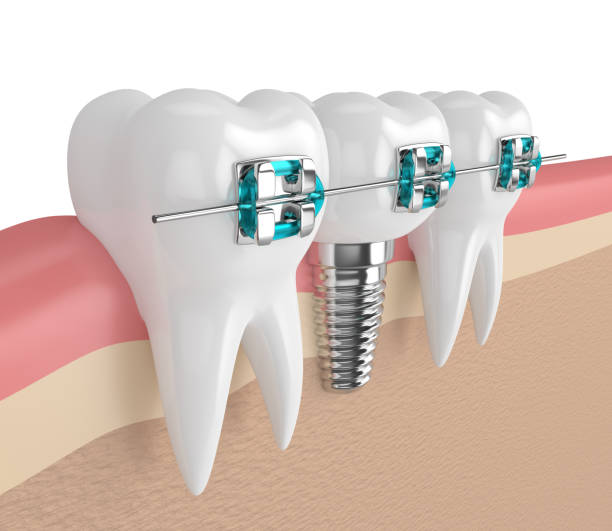 Lasting Solution for Missing Teeth