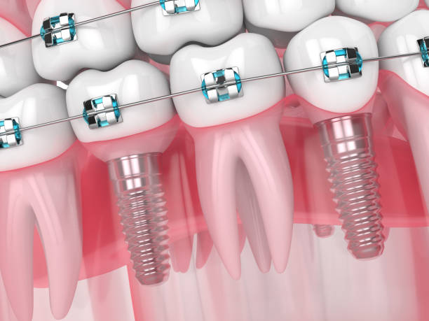 Dental Health with Implant Supported Dentures