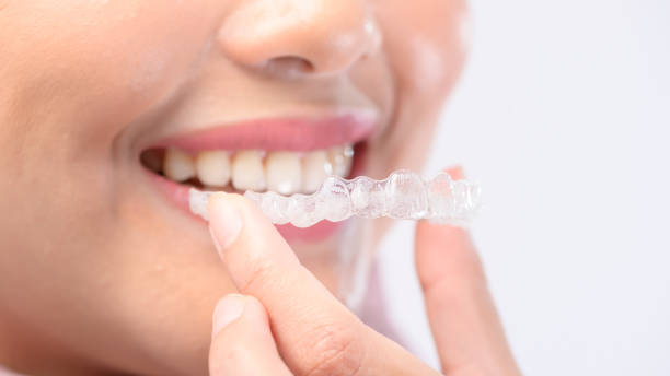 Invisalign Teeth Straightening