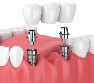 Implant Supported Bridges 