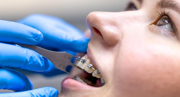 Traditional Braces