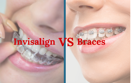 Comparisons: Aligners vs. Metal Braces
